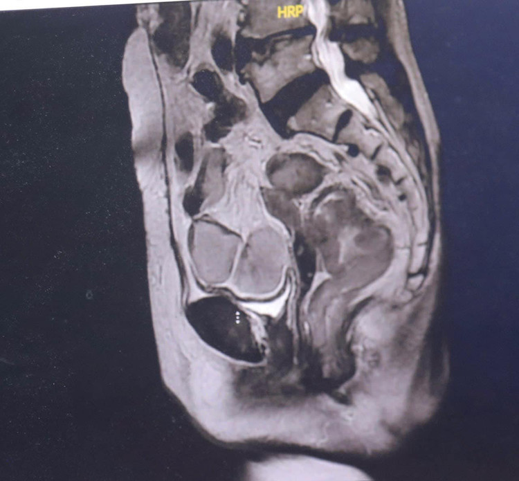 Hình ảnh khối u trong lòng đại tràng - Ảnh BVCC