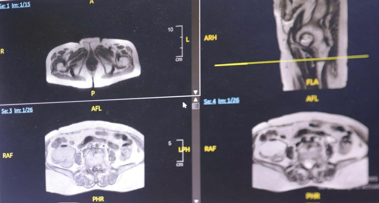 Hình ảnh khối u trên phim chụp - Ảnh BVCC