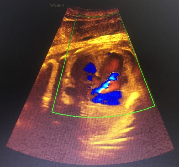 Hình ảnh siêu âm phát hiện ra bất thường của bệnh nhân