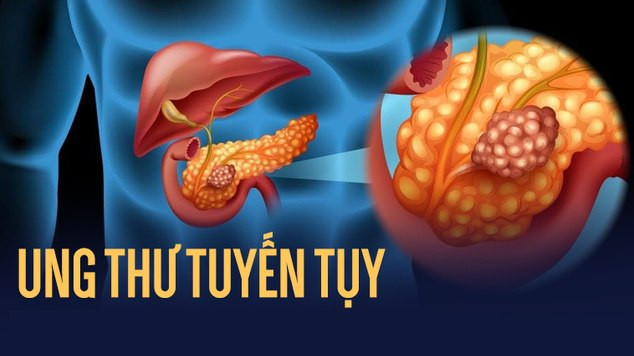 Cách phát hiện sớm ung thư tụy sâu trong ổ bụng, ác tính, tử vong cao ảnh 1