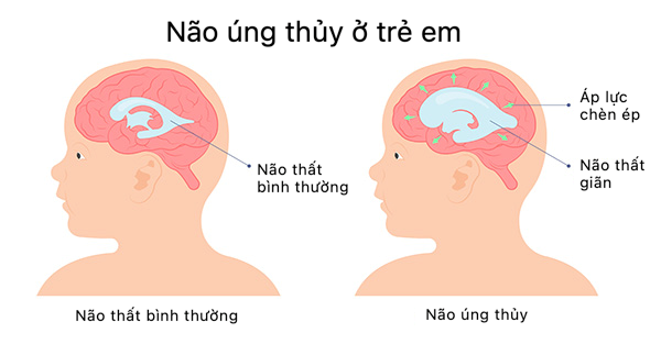 Hầu hết các trường hợp não úng thủy có thể điều trị? ảnh 1