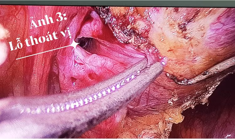 Sau khi mạc nối và bờm mỡ được gỡ xuống lộ ra một lỗ thoát vị sâu hoắm trên thành bụng