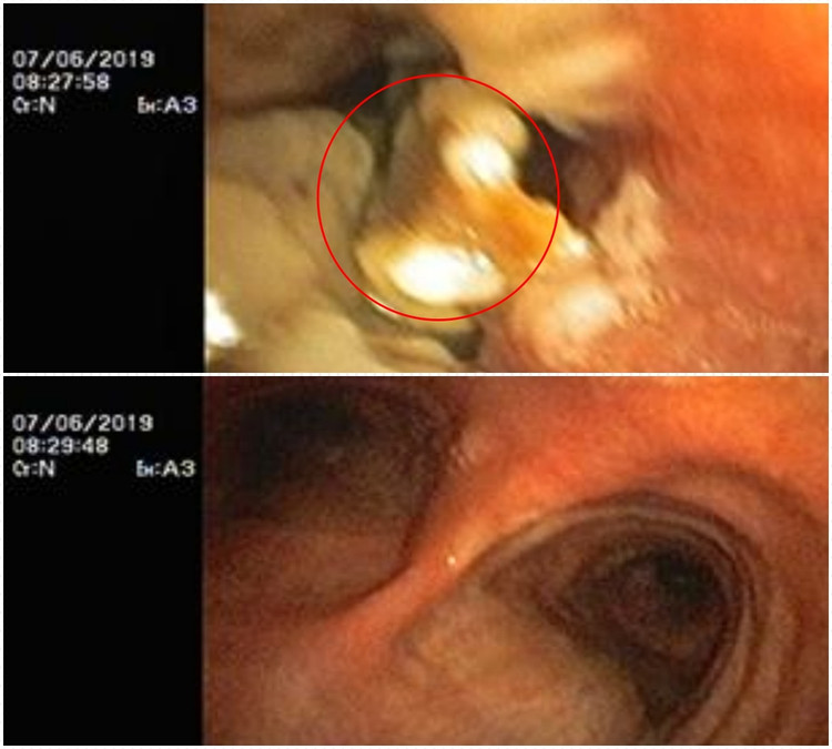 Mảnh xương cá trong phế quản bệnh nhân gần 3 tháng đã được gắp ra. Mảnh xương cá trong phế quản bệnh nhân gần 3 tháng đã được gắp ra.