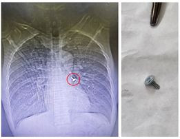 Hình ảnh đinh vít trong phế quản bệnh nhân và được lấy ra - Ảnh BVCC Hình ảnh đinh vít trong phế quản bệnh nhân và được lấy ra - Ảnh BVCC