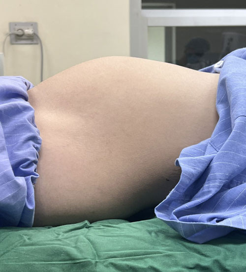 Vùng bụng của thiếu nữ to như đang mang thai 7 tháng - Ảnh BVCC