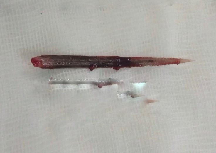 Dị vật đuôi cá đuối được lấy ra từ phổi bệnh nhân - Ảnh BVCC