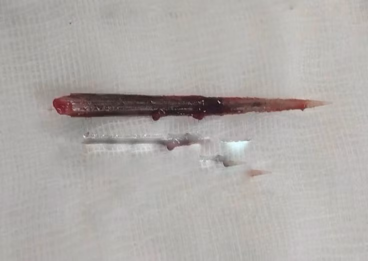 Dị vật đuôi cá đuối được lấy ra từ phổi bệnh nhân - Ảnh BVCC