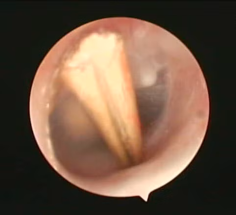 Cây gỗ trong ống tai trẻ - Ảnh BVCC