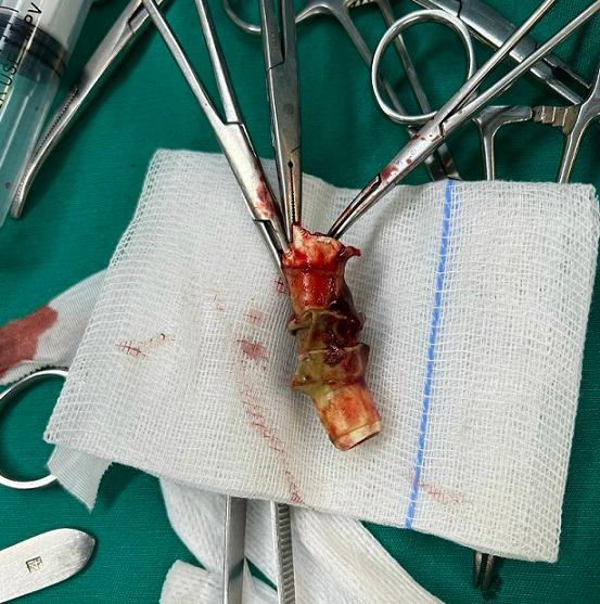 Hình ảnh canuyn gãy được gắp qua can thiệp ống cứng Hình ảnh canuyn gãy được gắp qua can thiệp ống cứng