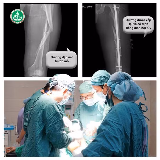 Phẫu thuật cho bệnh nhân bị cây đổ dập nát xương đùi - Ảnh BVCC