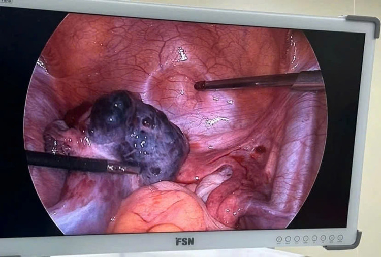 Buồng trứng của bệnh nhân tím đen do nghẹt mạch máu nuôi quá lâu. Ảnh: BSCC.