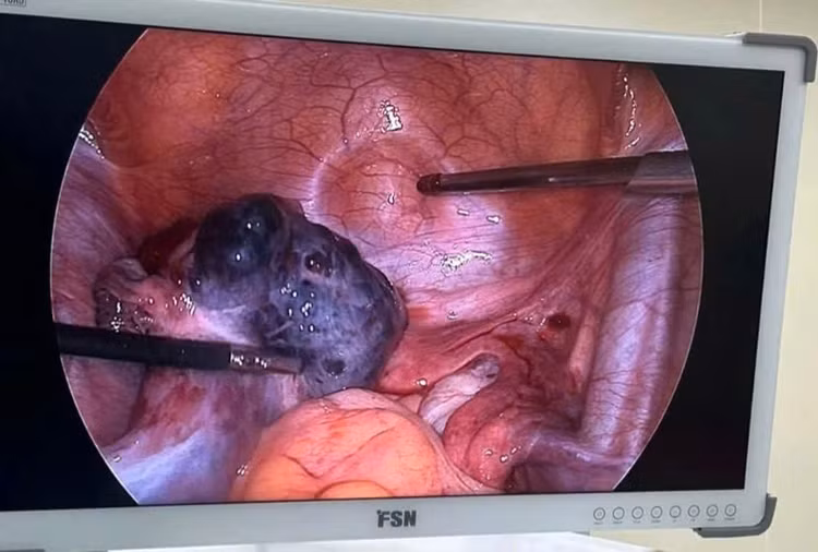 Buồng trứng của bệnh nhân tím đen do nghẹt mạch máu nuôi quá lâu. Ảnh: BSCC.