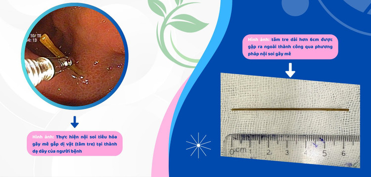 Tăm tre được phẫu lấy ra - Ảnh BVCC