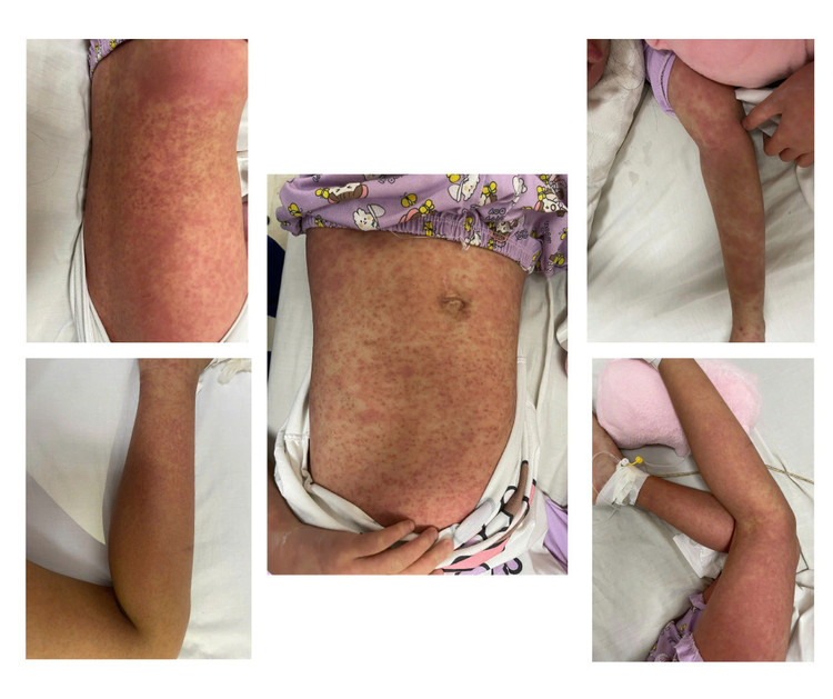 Dị ứng thuốc hội chứng Dress - Ảnh BVCC