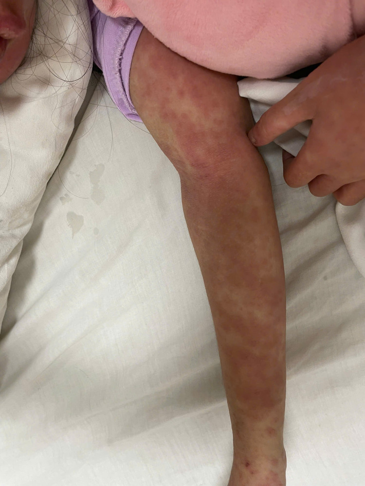 Trẻ bị phát ban toàn thân do dị ứng thuốc - Ảnh BVCC