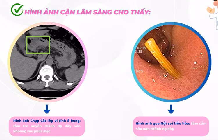 Hình ảnh tăm tre cắm sâu vào dạ dày trên phim chụp - Ảnh BVCC