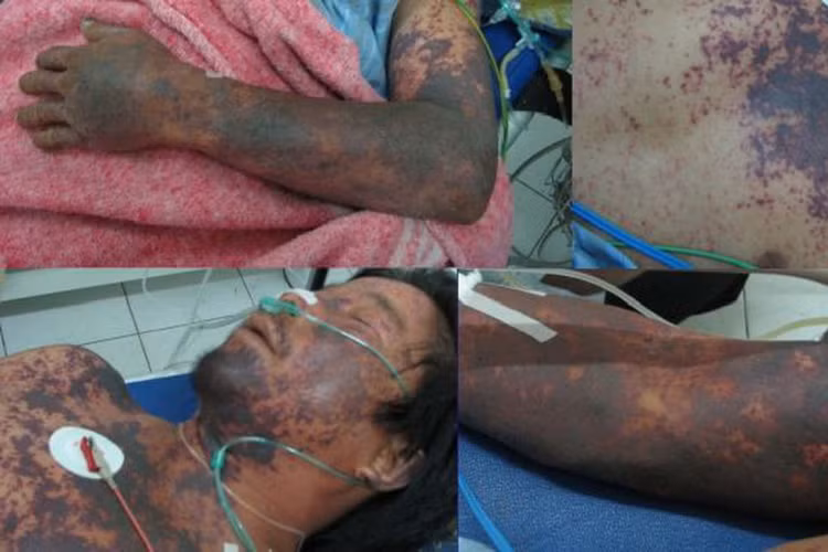 Ăn tiết canh viêm màng não do liên cầu khuẩn lợn dễ điếc tai