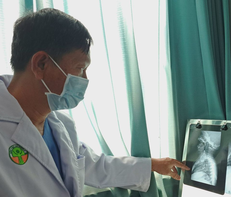 Lấy kim tây hơn 3 cm trong thực quản bé trai 10 tháng tuổi - ảnh BVCC