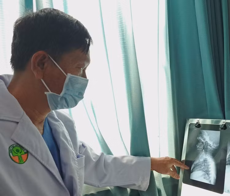 Lấy kim tây hơn 3 cm trong thực quản bé trai 10 tháng tuổi - ảnh BVCC