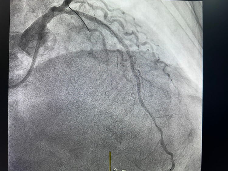 Huyết khối trên phim chụp - ảnh BVCC