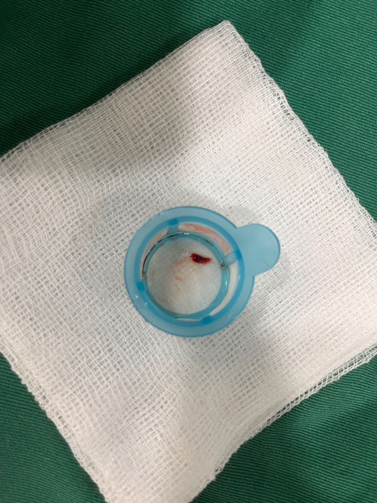 Huyết khối được lấy ra - Ảnh BVCC