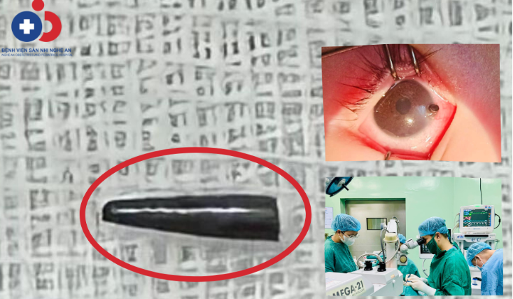 Bé 9 tháng tuổi bị ruột bút chì xuyên thủng nhãn cầu - ảnh BVCC