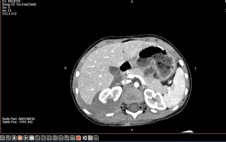 Hình ảnh vỡ thận trên phim chụp - Ảnh BVCC