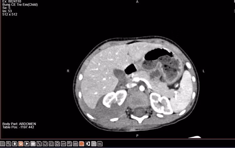 Hình ảnh vỡ thận trên phim chụp - Ảnh BVCC Hình ảnh vỡ thận trên phim chụp - Ảnh BVCC