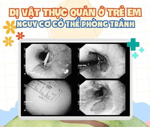 hình ảnh xương hóc qua nội soi