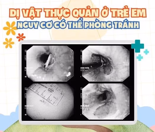 hình ảnh xương hóc qua nội soi