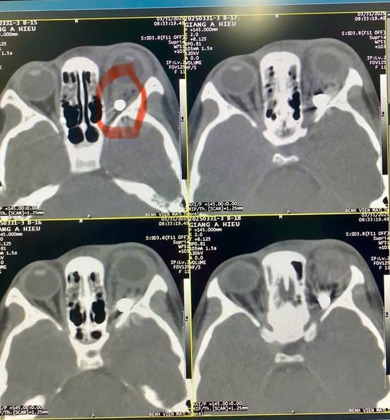 Kết quả chụp chiếu phát hiện có dị vật hình tròn trong hốc mắt kích thước khoảng 3-4mm, nghi là viên bi sắt - Ảnh BVCC