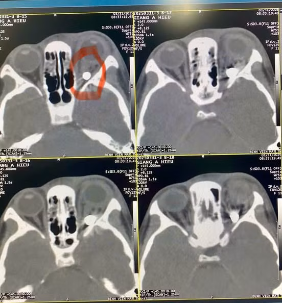 Kết quả chụp chiếu phát hiện có dị vật hình tròn trong hốc mắt kích thước khoảng 3-4mm, nghi là viên bi sắt - Ảnh BVCC