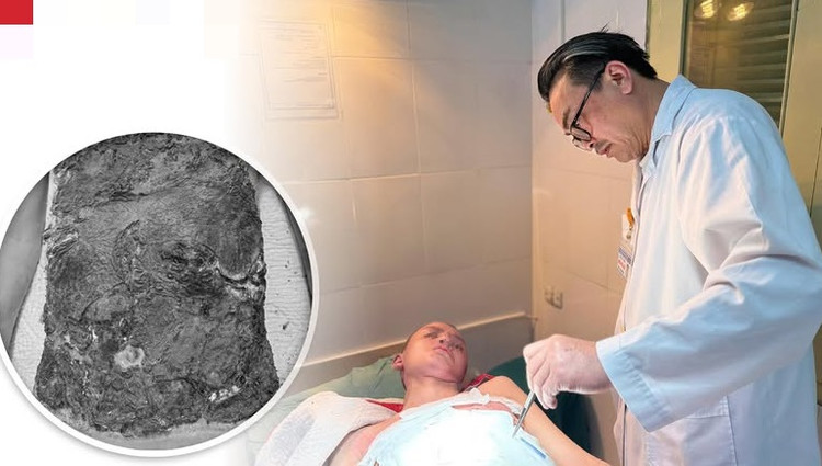 Trẻ 14 tuổi nhiễm trùng nặng do dùng thuốc nam chữa bỏng cồn - Ảnh BVCC