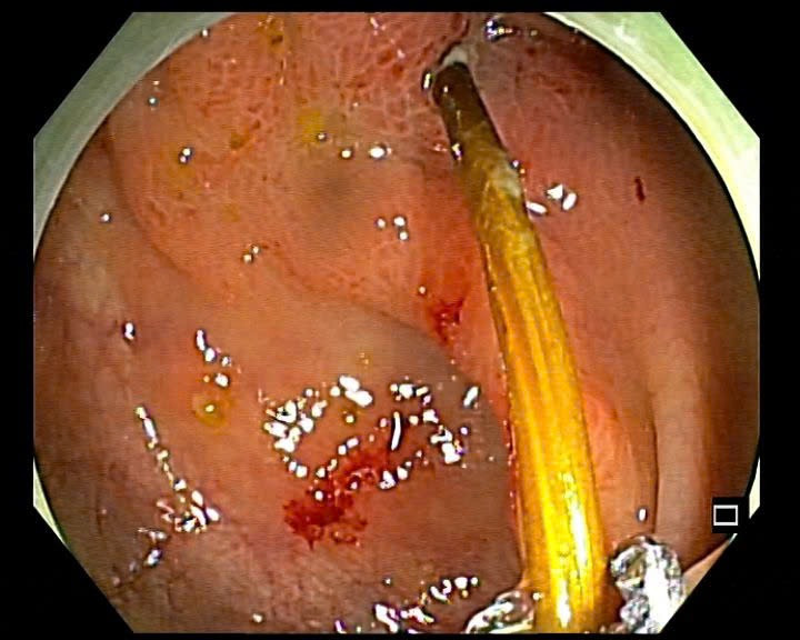Hình ảnh chiếc tăm đâm xuyên qua thành đại tràng của bệnh nhân - Ảnh BVCC