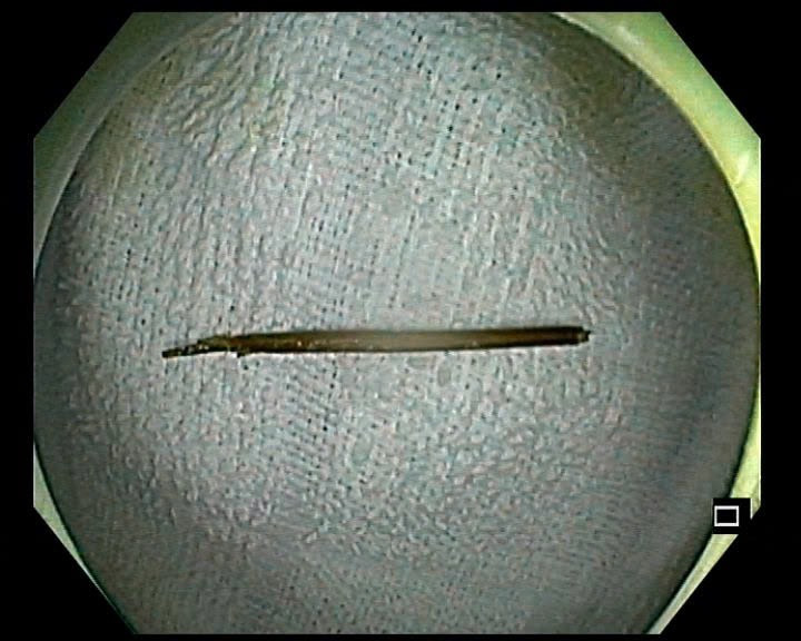 Hình ảnh chiếc tăm nhọn dài 6 cm được lấy ra ngoài - Ảnh BVCC