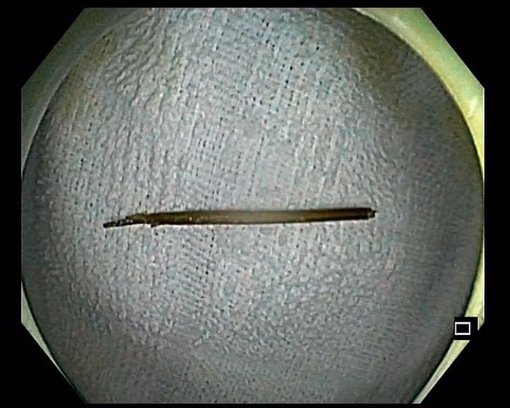 Hình ảnh chiếc tăm nhọn dài 6 cm được lấy ra ngoài - Ảnh BVCC