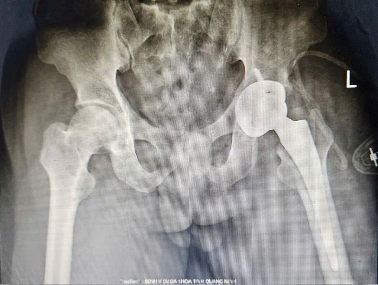 Bệnh nhân tiêu chỏm xương đùi được thay khớp háng trái nhân tạo bằng kỹ thuật SuperPath. - Ảnh BVCC Bệnh nhân tiêu chỏm xương đùi được thay khớp háng trái nhân tạo bằng kỹ thuật SuperPath. - Ảnh BVCC