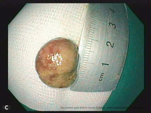 Khối polyp được lấy ra - Ảnh BVCC