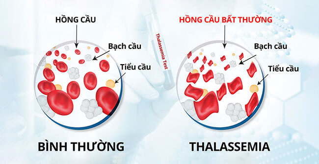 Gen bệnh Thalassemia di truyền từ cha mẹ sang con.
