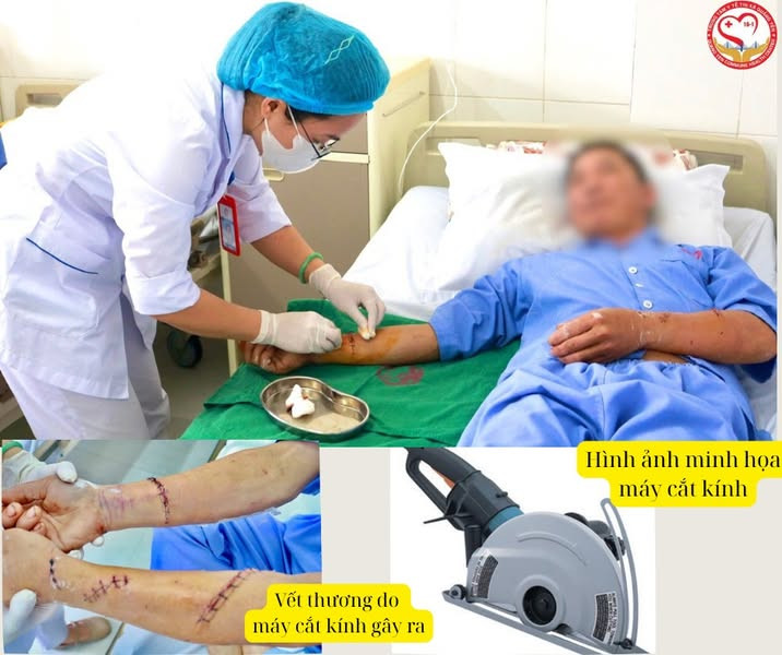 Cơn ác mộng của người đàn ông 2 lần bị lưỡi cưa cắt &quot;đứt&quot; tay - Ảnh BVCC