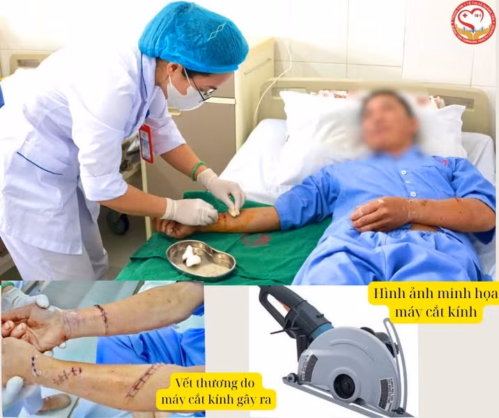 Cơn ác mộng của người đàn ông 2 lần bị lưỡi cưa cắt "đứt" tay - Ảnh BVCC