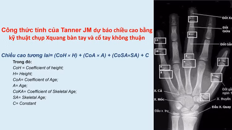 Một phương pháp dự báo chiều cao (Phương pháp Tanner JM)