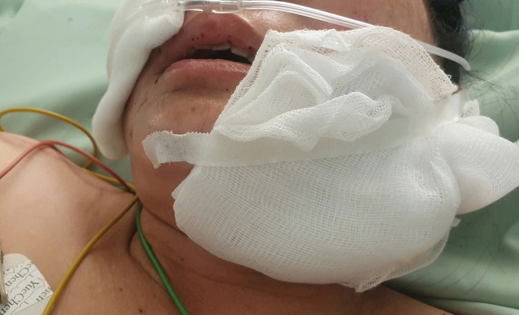 Bệnh nhân bị thương nặng nề ở vùng mặt - Ảnh BVCC