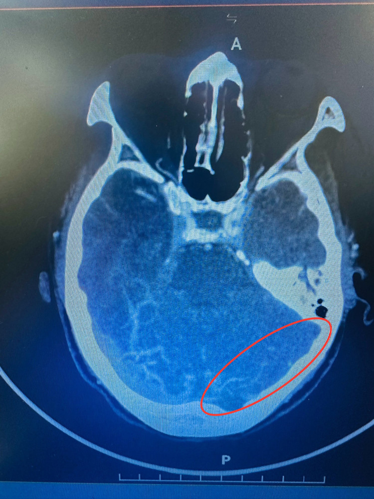 Tổn thương não trên phim chụp - Ảnh BSCC