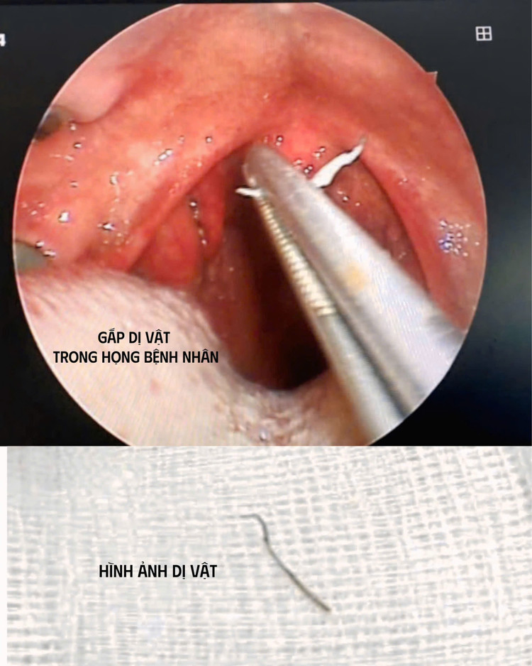Dị vật trong amidan của bệnh nhân được các bác sĩ gắp ra - Ảnh BVCC