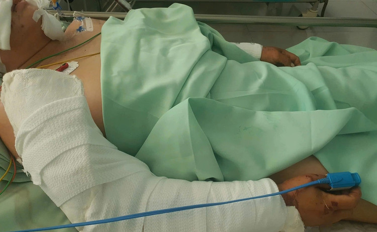 Hai cánh tay của bệnh nhân bị chó pitbull cắn ở nhiều vị trí - Ảnh BVCC