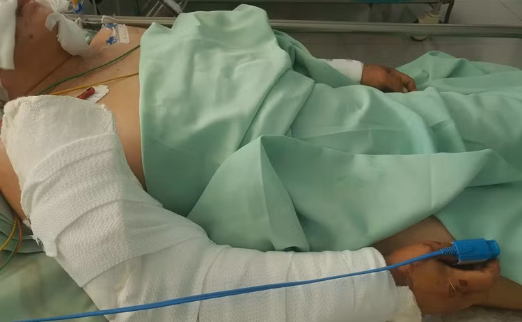 Hai cánh tay của bệnh nhân bị chó pitbull cắn ở nhiều vị trí - Ảnh BVCC