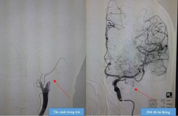 Kết quả chụp CHT sọ não của bệnh nhân đột quỵ