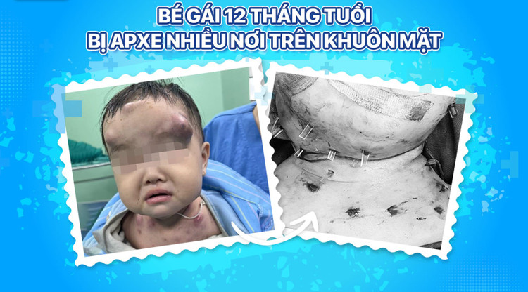 Bệnh nhi được phẫu thuật đặt dẫn lưu các ổ mủ