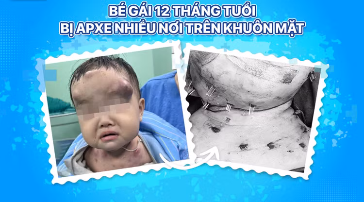 Bệnh nhi được phẫu thuật đặt dẫn lưu các ổ mủ